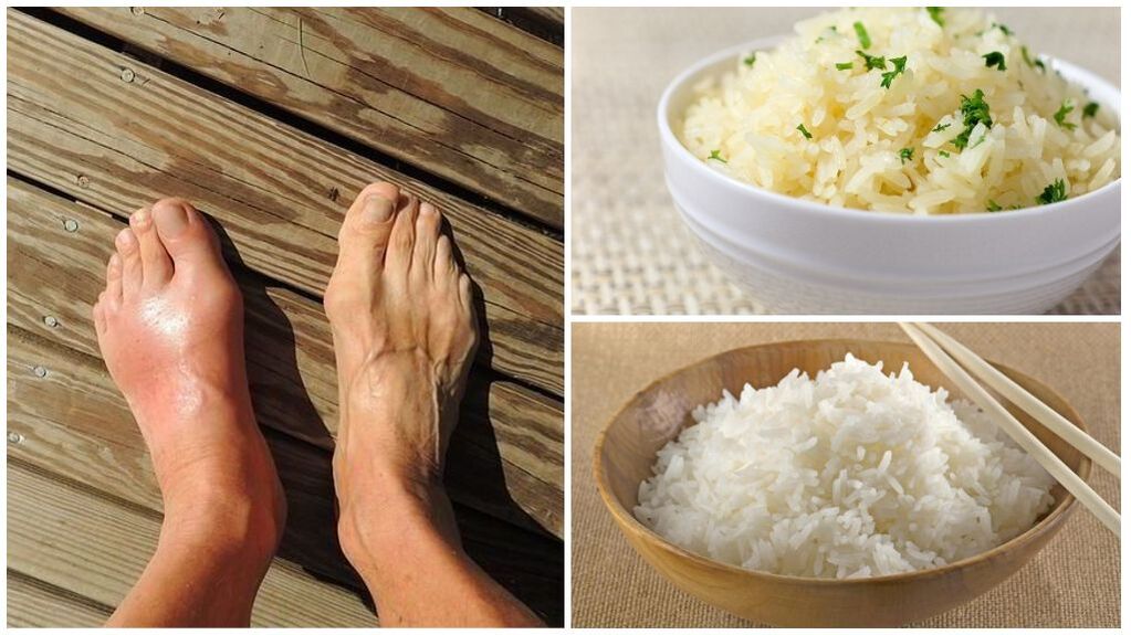 Un régime à base de riz est recommandé pour les patients souffrant de goutte. 
